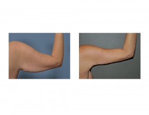 Right Armlift results back view Dr Barry Eppley Indianapolis