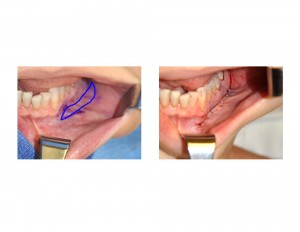 Shortening Mandibular Vestibuloplasty Dr Barry Eppley Indianapolis