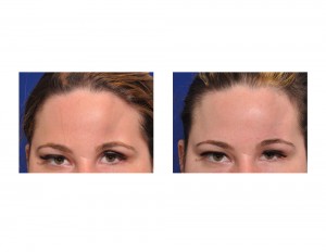 Dermal Fat Graft Reconstruction Left Forehead Dr Barry Eppley Indianapolis