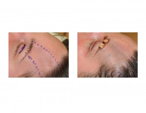 Dermal Fatr Graft Reconstruction Forehead intraop result Dr Barry Eppley Indianapolis