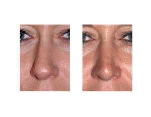 Hump Reduction Rhinoplasty result front view Dr Barry Eppley Indianapolis