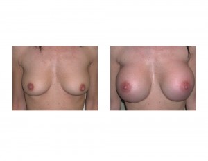 Large Breast Augmentation in Petite Female result front view Dr Barry Eppley Indianapolis