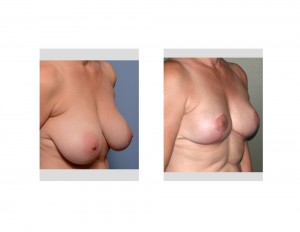 Large Breast Reduction result oblique view