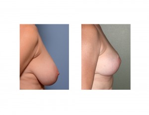 Large Breast Reduction result side view Dr Barry Eppley Indianapolis