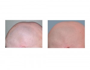 Sagittal Crest Reduction results side view
