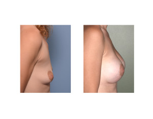 Breast Asymmetry Breast Augmentation result side view