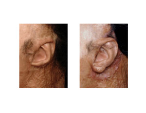 Burn Ear Reconstruction 2 result Dr Barry Eppley Indianapolis