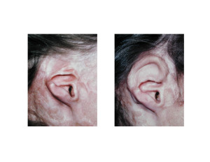 Burned Ear Reconstruction with Rib Graft result Dr Barry Eppley Indianapolis
