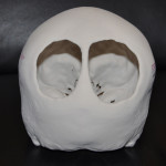 Congenital Occipital Skull Defects Dr Barry Eppley Indianapolis