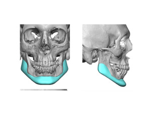 Custom Jawline Implant Design for Jaw Reconstruction Dr Barry Eppley Indianapolis