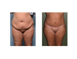 Extended Tummy Tuck results front view Dr Barry Eppley Indianapolis