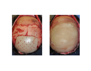 Extreme Occipital Augmentation intraop top view Dr Barry Eppley Indianapolis