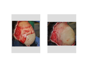 Extreme Occipital Augmentation result intraop oblique view
