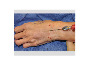 Fat Injections to the Hands Dr Barry Eppley Indianapolis