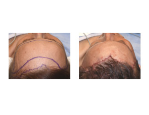 Forehead Reduction with Hairline Advancement intraop top view Dr Barry Eppley Indianapolis