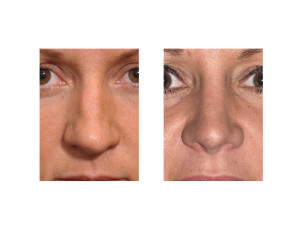Large Nose Female Rhinoplasty result front view
