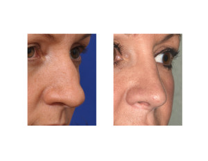 Large Nose Female Rhinoplasty result oblique view Dr Barry Eppley Indianapolis