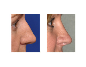Large Nose Female Rhinoplasty result side view