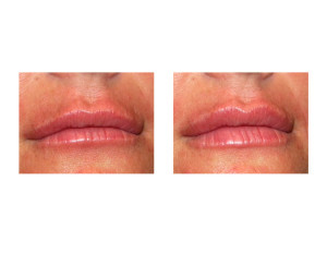 Lip Implants result front view Dr Barry Eppley Indianapolis