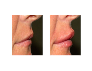 Lip Implants result side view Dr Barry Eppley Indianapolis