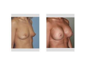 Nipple Lift Breast Augmentation results oblique view Dr Barry Eppley Indianapolis