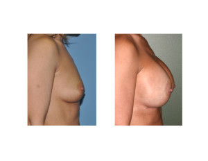 Nipple Lift Breast Augmentation results side view Dr Barry Eppley Indianapolis