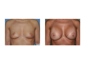 Nipple Lift Breast Augmnetation results frofnt view Dr Barry Eppley Indianapolis