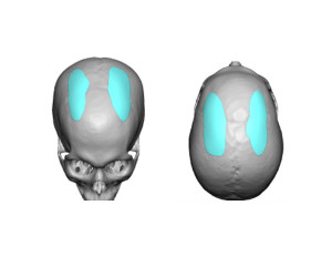 Parasagittal Skull Implant Designs Dr Barry Eppley Indianapolis