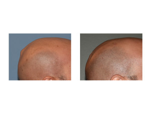 Skull Bump Reduction result side view Dr Barry Eppley Indianapolis