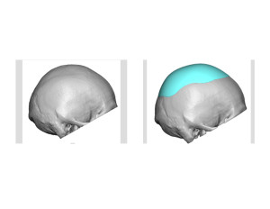 Skull Implant design for Sagittal Ridge Deformity side view Dr Barry Eppley Indianapolis