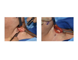 Tracheal Shave by Burring Reduction Dr Barry Eppley Indianapolis