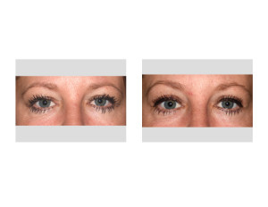 Upper Blepharoplasty (Eyelid Lifts) under Local Anesthesia Dr Barry Eppley Indianapolis