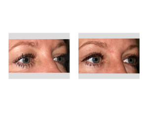 Upper Blepharoplasty (Eyelid Lifts) under Local Anesthesia oblique view Dr Barry Eppley Indianapolis