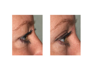 Upper Blepharoplasty (Eyelid Lifts) under Local Anesthesia side view Dr Barry Eppley Indianapolis