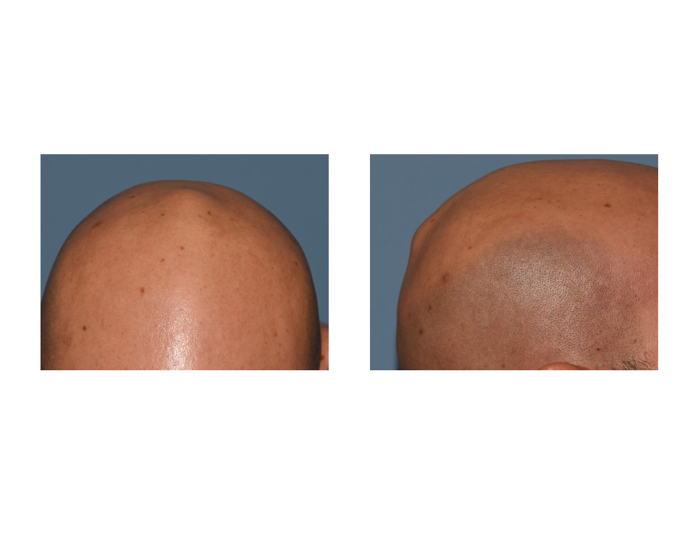 Plastic Surgery Case Study Reduction Of The Vertex Skull Bump 