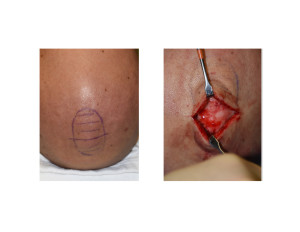 Vertex Skull Bump exposed intraop Dr Barry Eppley Indianapolis