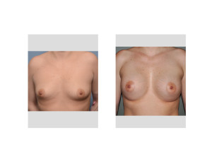 Breast Augmentation and Stretch Marks result front view Dr Barry Eppley Indianapolis
