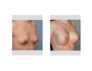 Breast Augmentation and Stretch Marks result oblique view Dr Barry Eppley Indianapolis