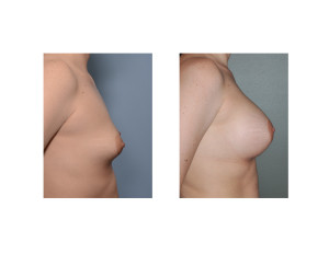 Breast Augmentation and Stretch Marks result side view Dr Barry Eppley Indianapolis