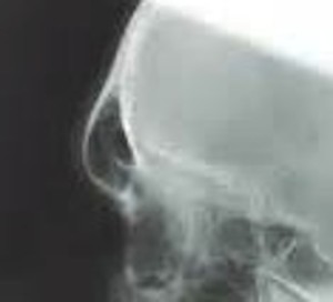 Brow Bone Thockness X-Ray Dr Barry Eppley Indianapolis