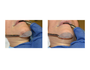 Custom Chin Implant placement intraop Dr Barry Eppley Indianapolis