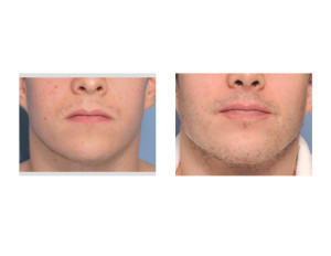 Custom Jawline Implant result front view Dr Barry Eppley Indianapolis