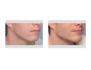 Custom Jawline Implant result oblique view Dr Barry Eppley Indianapolis