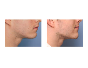 Custom Jawline Implant result side view Dr Barry Eppley Indianapolis