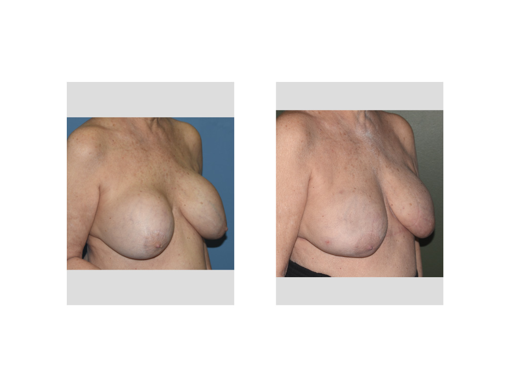 Breast Options After Breast Implant Removal
