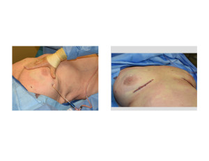 Fat Grafting to Breasts after Implant Removal intraop Dr Barry Eppley Indianapolis