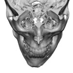 Jaw Asymmetry 3D CT scan Dr Barry Eppley Indianapolis
