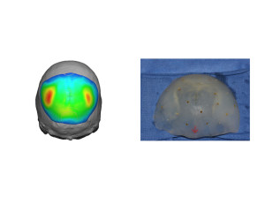 Perforated Skull Implant Design for Occipital Dents