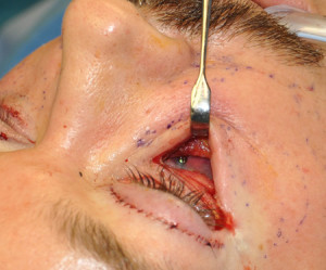 Screw Fixation Tear Trough Implants Dr Barry Eppley Indianapolis