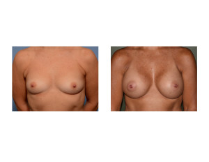 Sientra Textured Shaped Breast Implants Augmentation results front view Dr Barry Eppley Indianapolis
